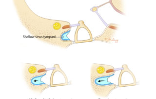 The sinus tympani is of variable depth; it may be shallow or extend posterior to the facial nerve. The sinus tympani is of variable depth; it may be shallow or extend posterior to the facial nerve.