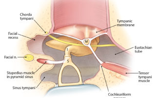 Details of the posterior mesotympanic spaces (facial recess and sinus tympani). (Used with permission from Jackler RK. The surgical anatomy of cholesteatoma. Otolaryngol Clin NA 1989;22:883–896.) Details of the posterior mesotympanic spaces (facial recess and sinus tympani). (Used with permission from Jackler RK. The surgical anatomy of cholesteatoma. Otolaryngol Clin NA 1989;22:883–896.)