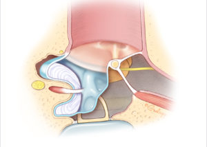 Cholesteatoma involving the posterior mesotympanic spaces (facial recess and sinus tympani). The long process of the incus and stapes superstructure is frequently eroded. (Used with permission from Jackler RK. The surgical anatomy of cholesteatoma. Otolaryngol Clin NA 1989;22:883–896.)