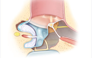 Cholesteatoma involving the posterior mesotympanic spaces (facial recess and sinus tympani). The long process of the incus and stapes superstructure is frequently eroded. (Used with permission from Jackler RK. The surgical anatomy of cholesteatoma. Otolaryngol Clin NA 1989;22:883–896.) Cholesteatoma involving the posterior mesotympanic spaces (facial recess and sinus tympani). The long process of the incus and stapes superstructure is frequently eroded. (Used with permission from Jackler RK. The surgical anatomy of cholesteatoma. Otolaryngol Clin NA 1989;22:883–896.)