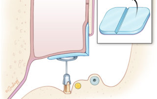 A scored piece of cartilage with perichondrium intact spanning the tympanic membrane and repairing a scutal defect.
