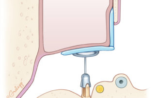 Two pieces of cartilage to both reinforce the tympanic membrane and also to repair an epitympanic defect.