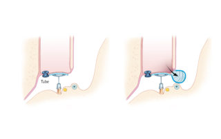 Cholesteatoma recurrence may occur despite adequate middle ear ventilation.