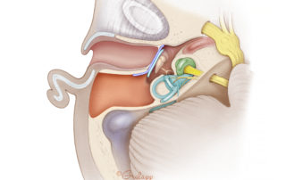Intact canal wall tympanomastoidectomy with fascia tympanoplasty and cartilage graft.