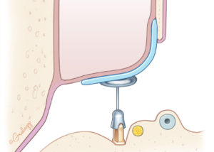 A single piece of cartilage spanning the tympanic membrane and repairing a scutal defect. Note that the cartilage is placed on the ear canal side. Cartilage placed on the mastoid side is less effective in discouraging recurrence.