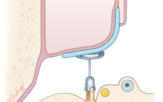 A single piece of cartilage spanning the tympanic membrane and repairing a scutal defect. Note that the cartilage is placed on the ear canal side. Cartilage placed on the mastoid side is less effective in discouraging recurrence.