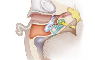 Recurrent cholesteatoma following an intact canal wall tympanomastoidectomy. While a well-placed cartilage graft reduces the risk, recurrent cholesteatoma may occur even in a narrow slit between the cartilage and scutum. This type of recurrence is especially probable when the opposite ear also has a cholesteatoma. Because of the high risk of recurrence with intact canal wall procedures in patients with bilateral disease, consideration should be given for a primary canal wall down approach in these patients.