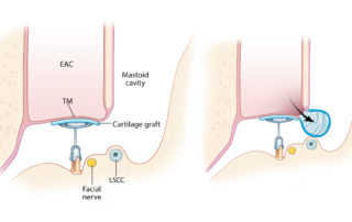 Recurrent cholesteatoma with retraction between the scutum and a cartilage graft which did not fully seal the epitympanum. EAC, external auditory canal; TM, tympanic membrane; LSCC, lateral semicircular canal.