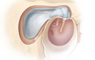 Outer matrix and keratin removed completing a retrograde mastoidectomy. This differs from a Bondy modified radical mastoidectomy as the uninvolved mastoid is not disturbed.