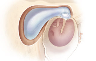 Exposed cholesteatoma.
