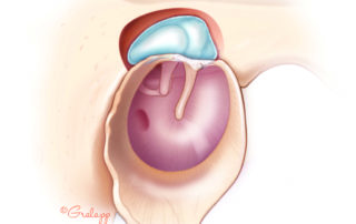 Small epitympanic cholesteatoma exteriorized by an atticotomy.