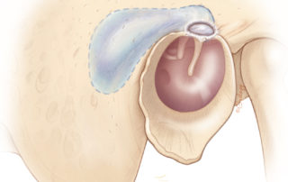 Retrograde approach removing only that portion of the mastoid overlying the cholesteatoma as an alternative to thorough removal of mastoid cellularity.