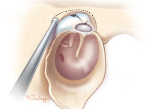 Limited epitympanic disease can be handled by an atticotomy.