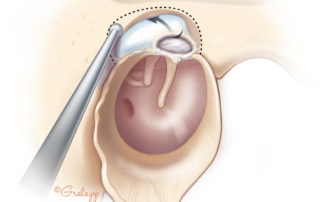 Limited epitympanic disease can be handled by an atticotomy.