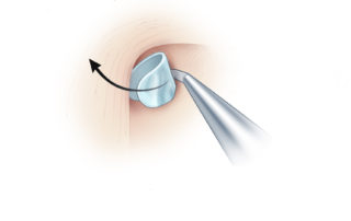 Dissection of the cholesteatoma from the anterior epitympanic space deep to the malleus head.