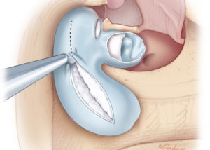 Opening the cholesteatoma matrix to expose the entrapped keratin.