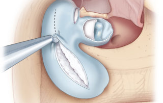Opening the cholesteatoma matrix to expose the entrapped keratin.