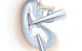 Keratin is fed into a suction.