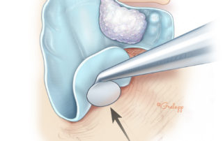 Dissection of the matrix off the floor of the mastoid. The facial nerve is seldom involved in the mastoid segment, but care must be taken in observing from possible lateral semicircular canal fistula.