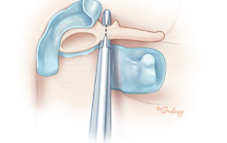 Matrix is dissected off the lateral aspect of the malleus head. A malleus nipper is preparing to sever the malleus neck. If this segment of bone is stout, then it can be thinned with a 1-mm diamond drill before nipping.