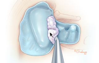 Removing keratin off the matrix adherent to the ossicles.