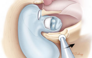 Lowering of the canal wall, also known as the facial ridge because the facial nerve lies in its base.