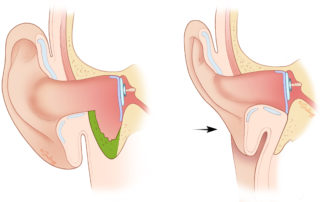Removal of the mastoid tip creates a smaller cavity. This is indicated in canal wall down surgery in an extensively pneumatized temporal bone.
