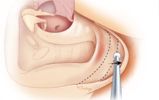 Removal of the mastoid tip. The facial nerve is not related to the tip itself: it exits the mastoid bone anteriorly beneath the digastric ridge.