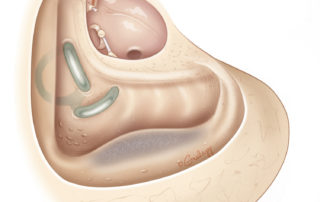 Completed canal wall down mastoidectomy before middle ear reconstruction.