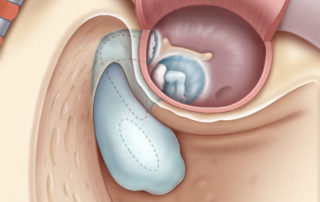 Epitympanic cholesteatoma with involvement of the mastoid.