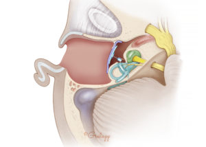 Canal wall down tympanomastoidectomy cavity with fascia tympanoplasty, cartilage graft, and partial ossicular replacement prosthesis.