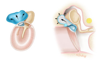 With further growth, the cholesteatoma continues to accumulate keratin as it expands toward the aditus-ad-antrum.