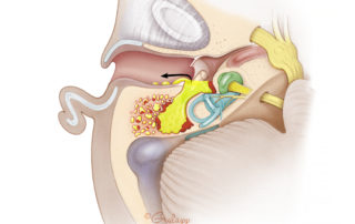 Chronic otitis media without cholesteatoma.