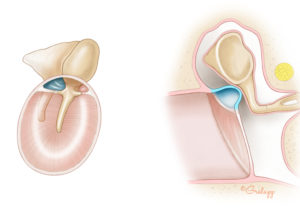 Acquired cholesteatoma begins as a retraction pocket in the tympanic membrane, most often in the pars flaccida.