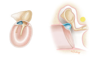 Acquired cholesteatoma begins as a retraction pocket in the tympanic membrane, most often in the pars flaccida.