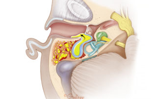 Infected cholesteatoma penetrating the mastoid via the aditus-ad-antrum. The excluded air cells contain purulence and granulation tissue.