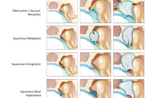 Existing theories of cholesteatoma formation. (Used with permission from Jackler RK, Santa Maria PL, Varav KY, Gguyen A, Blevins NB. A new theory on the pathogenesis of acquired cholesteatoma: mucosal traction. Laryngoscope 2015;125(Suppl 4):S1–S14.)