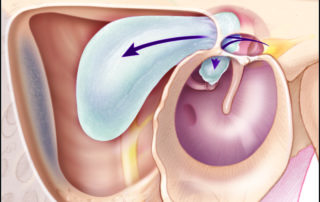 Posterior epitympanic cholesteatoma involving the mastoid which penetrated the epitympanum and posterior mesotympanum lateral to the ossicles.