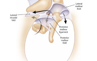 Cholesteatomas invade the middle ear and mastoid along fairly predictable pathways. Their growth is constrained by ligaments and mesenteries which are embryological remnants of the first branchial arch pouches which form the tympanic cavity. (Used with permission from Jackler RK. The surgical anatomy of cholesteatoma. Otolaryngol Clin NA 1989;22:883–896.)