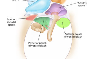 Cholesteatoma growth tends to follow spaces defined by ligaments and mesenteries which compartmentalize the middle ear. (Used with permission from Jackler RK. The surgical anatomy of cholesteatoma. Otolaryngol Clin NA 1989;22:883–896.)