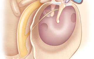 Anterior epitympanic cholesteatoma penetrates the supratubal recess and can involve the geniculate ganglion of the facial nerve (see section 8.9 Anterior Epitympanic Cholesteatoma). (Used with permission from Jackler RK. The surgical anatomy of cholesteatoma. Otolaryngol Clin NA 1989;22:883–896.)