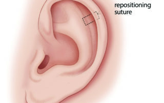 An anti-lopping suture in place. An anti-lopping suture in place.