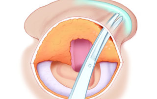 Placement of an anti-lopping suture begins with tunneling to expose antihelical fold. Placement of an anti-lopping suture begins with tunneling to expose antihelical fold.