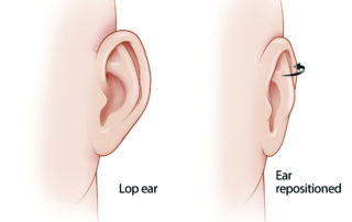 In closing a postauricular incision following tympanomastoid procedures, the pinna may rotate outward and develop a cosmetically undesirable prominence (i.e., lop ear). This is especially the case in children due to the flexibility of their cartilage. In closing a postauricular incision following tympanomastoid procedures, the pinna may rotate outward and develop a cosmetically undesirable prominence (i.e., lop ear). This is especially the case in children due to the flexibility of their cartilage.