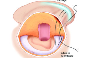 Placement of an anti-lopping suture. To avoid the suture pulling through the perichondrium while tying, the ear is pushed from its ventral side against the head. Placement of an anti-lopping suture. To avoid the suture pulling through the perichondrium while tying, the ear is pushed from its ventral side against the head.
