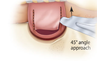 Incising the vertical limbs of the posterior ear canal flap.