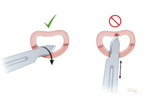 When cutting the skin, it is best to cut toward the surgeon to avoid possibly incising the anterior canal skin.