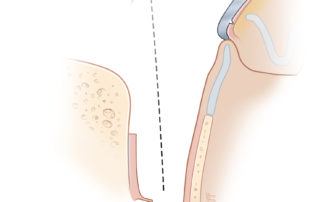 The Koerner’s flap is flipped outward and helped under a spiked, flat blade retractor (e.g., Perkin’s). This procedure enables a direct view down the ear canal with no overhanging soft tissue to obscure the surgeon’s view.