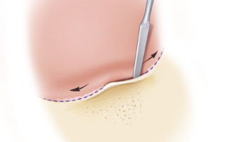 Developing the periosteal plane of the ear canal.