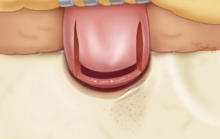 Completed incision of posterior ear canal flap.